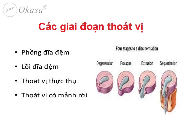 Hiểu về thoát vị đĩa đệm lưng có mảnh rời
