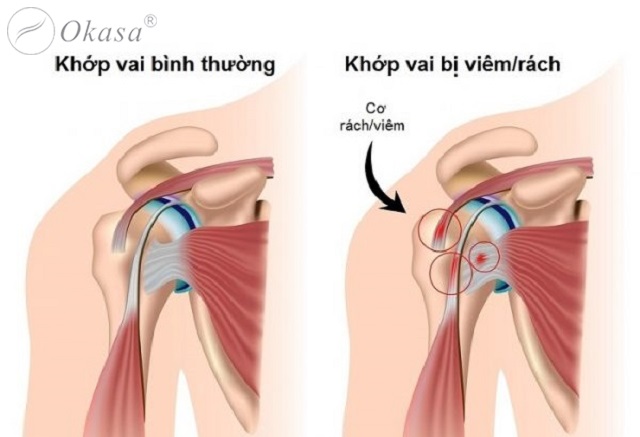 Hiểu về tình trạng rách xoay chóp vai