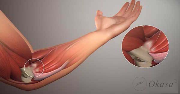 Hiểu về viêm điểm bám gân lồi cầu xương cánh tay