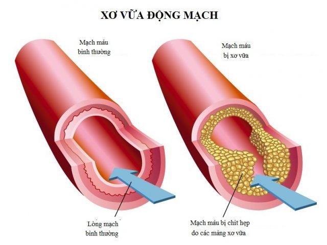 Hiểu về xơ vữa động mạch chi dưới