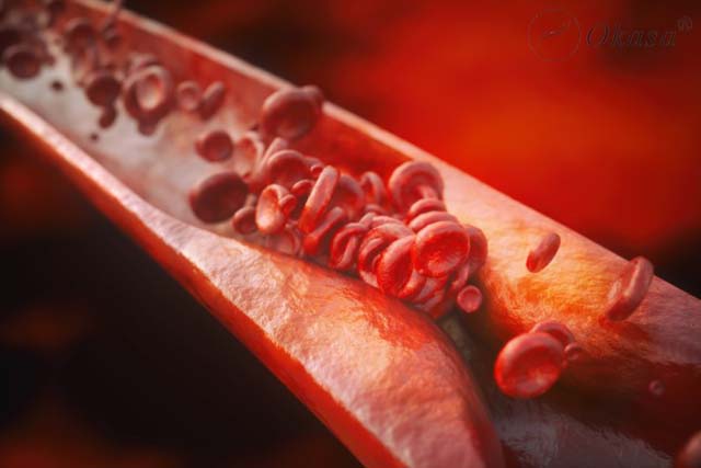 Hiểu về xơ vữa động mạch chi dưới