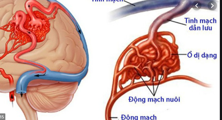 hội chứng chùm đuôi ngựa do dị dạng mạch máu tủy sống
