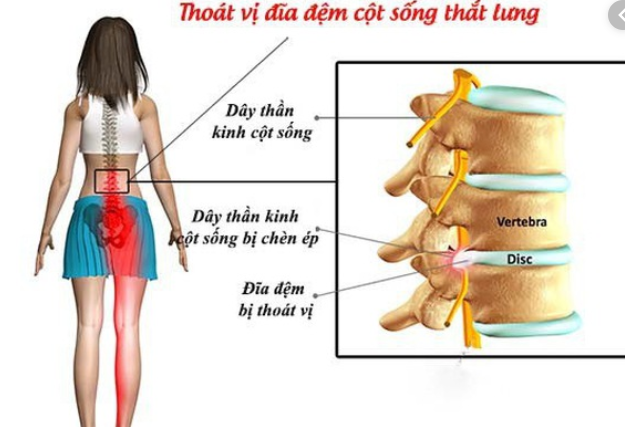 hội chứng chùm đuôi ngựa do thoát vị đĩa đệm