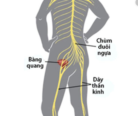 hội chứng chùm đuôi ngựa