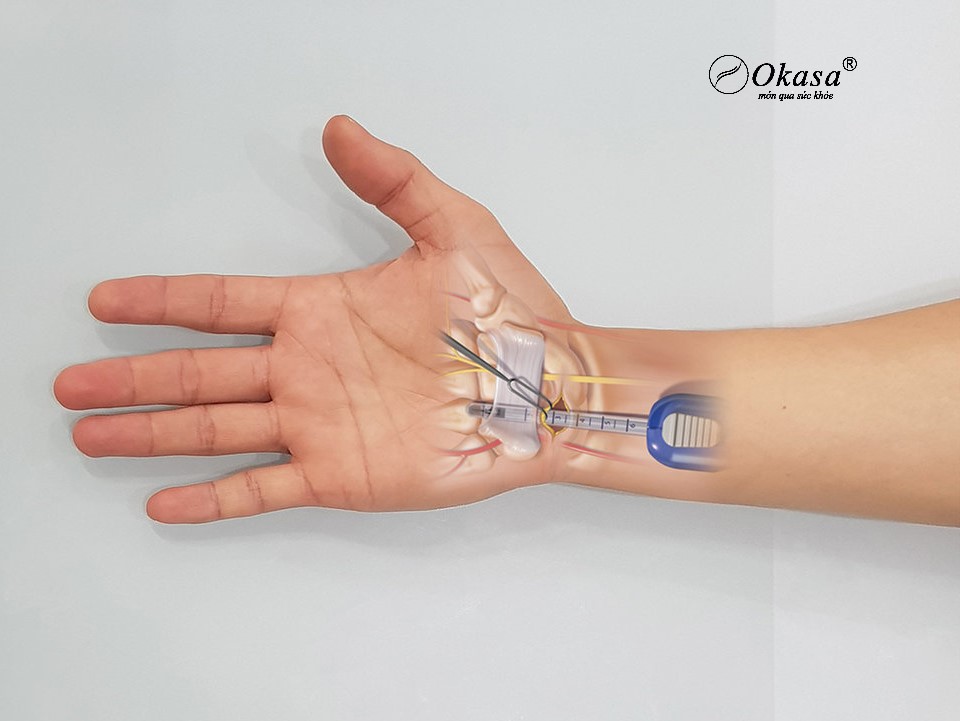 hội chứng ống cổ tay