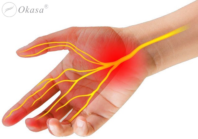 Hội chứng ống cổ tay là gì? Cách điều trị