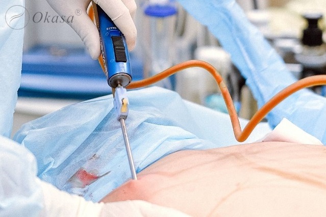 Hút mỡ để giảm cân có phải giải pháp tối ưu ?