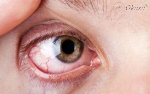 Huyết áp tăng cao gây hại cho mắt