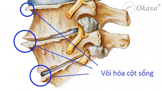 Khi điều trị vôi hóa cột sống cần lưu ý những gì?