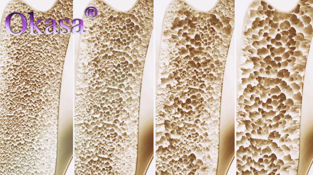 các mức độ loãng xương