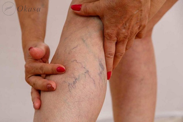 Massage cho người bị suy giãn tĩnh mạch chân