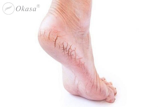 Massage và 6 mẹo giúp bạn không bị nhiễm trùng và nứt gót chân trong mùa đông