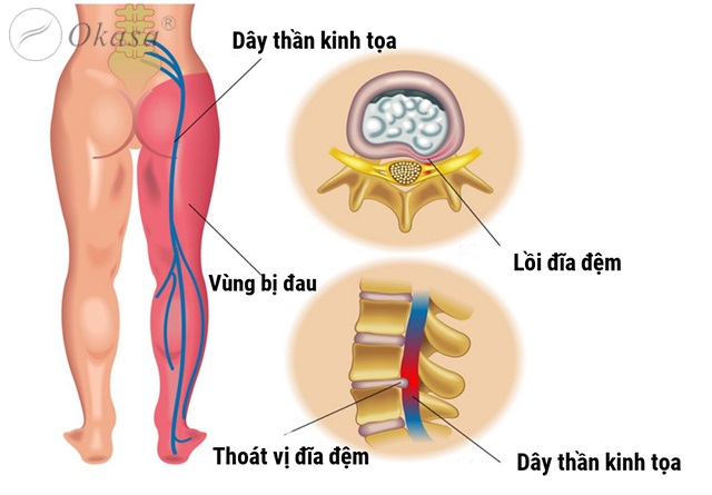 Một số phương pháp massage giúp trị đau thần kinh tọa