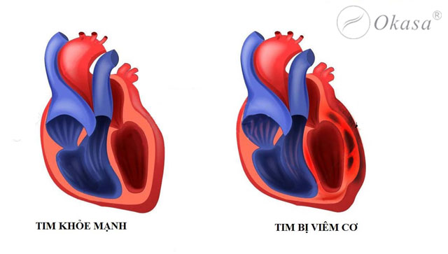 Mức độ nguy hiểm của viêm cơ tim
