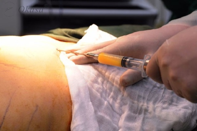 Người béo phì sau khi hút mỡ có thể gặp một số vấn đề về sức khỏe