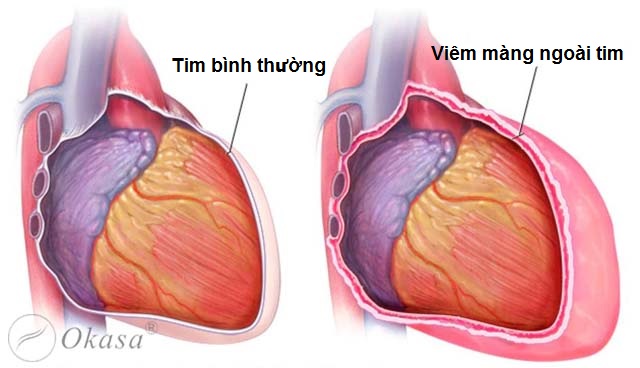 Nguyên nhân gây bệnh viêm màng ngoài tim
