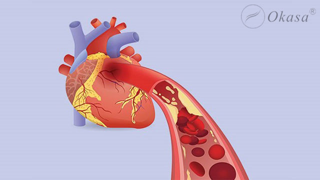 Nguyên nhân gây ra tình trạng thiếu máu cơ tim