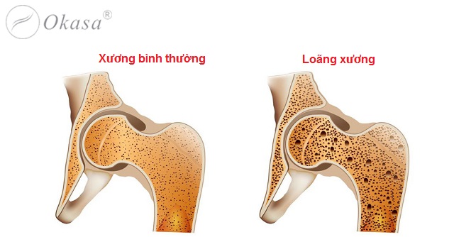 Nguyên nhân phổ biến gây đau nhức xương khớp ở người già