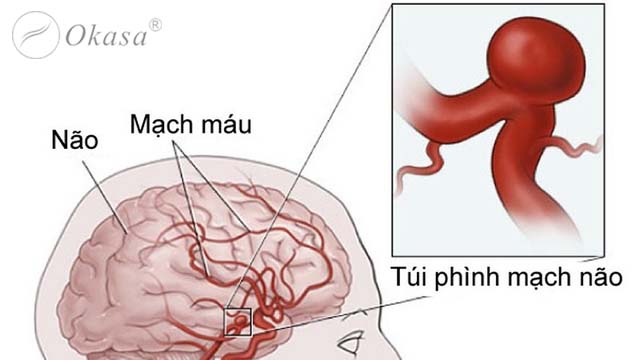 Nguyên nhân và dấu hiệu phình mạch máu não
