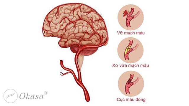 Nguyên nhân và dấu hiệu phình mạch máu não
