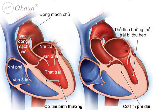 Nguyên nhân và triệu chứng của bệnh cơ tim phì đại