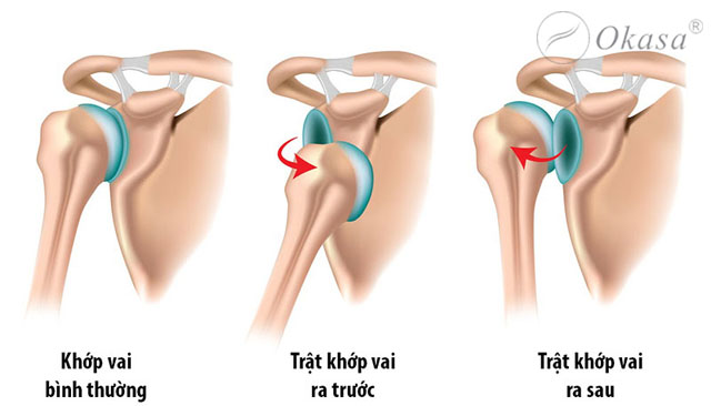 Nguyên nhân và triệu chứng nhận biết đau khớp vai