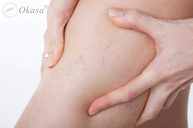 Nguyên nhân và triệu chứng suy tĩnh mạch sâu