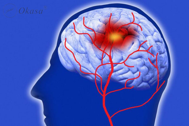 Nguyên nhân và triệu chứng tai biến mạch máu não