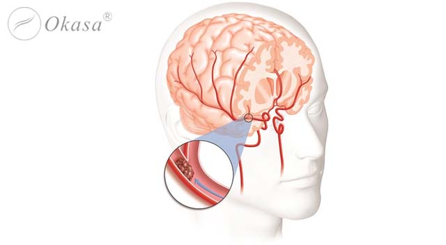 Nguyên nhân và triệu chứng xơ vữa động mạch não