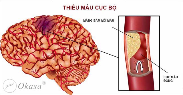 Nguyên nhân và triệu chứng xơ vữa động mạch não