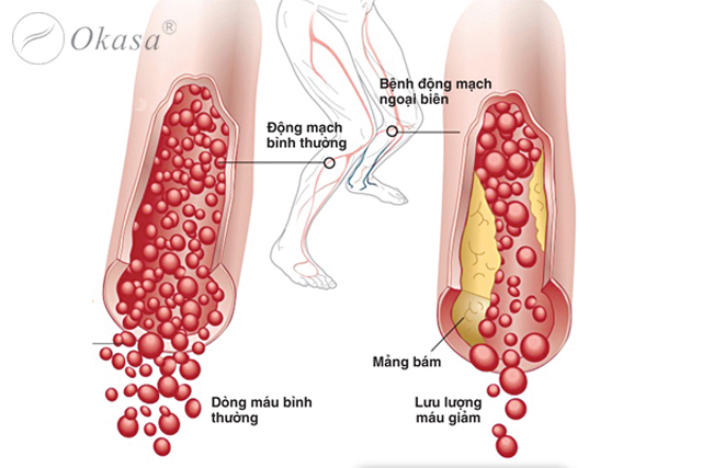 Nhận biết tình trạng đau cách hồi