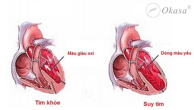 Nhguyên nhân gây bệnh suy tim