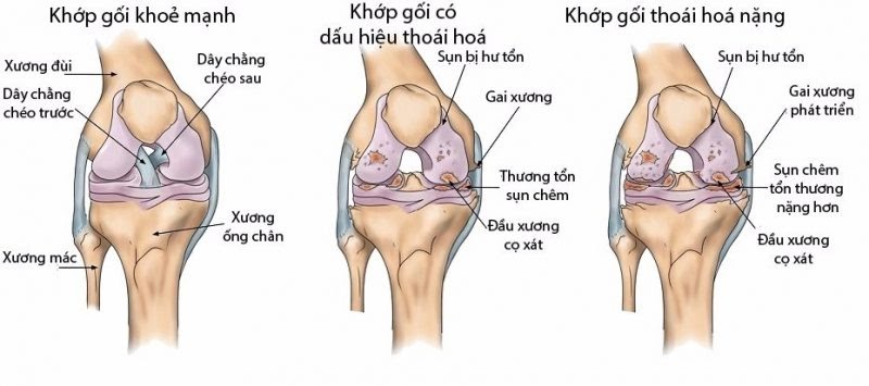 nhức chân từ đầu gối trở xuống do đâu