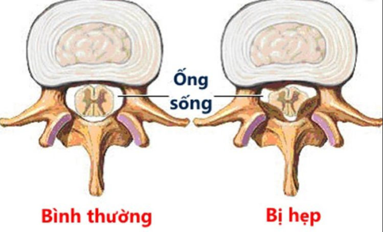 nhức chân từ đầu gối trở xuống là bệnh gì
