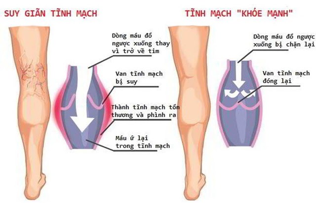 nhức chân từ đầu gối trở xuống là dấu hiệu của bệnh gì