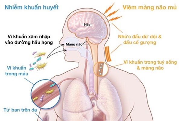 nhức đầu liên tục nhiều ngày do nhiễm trùng não