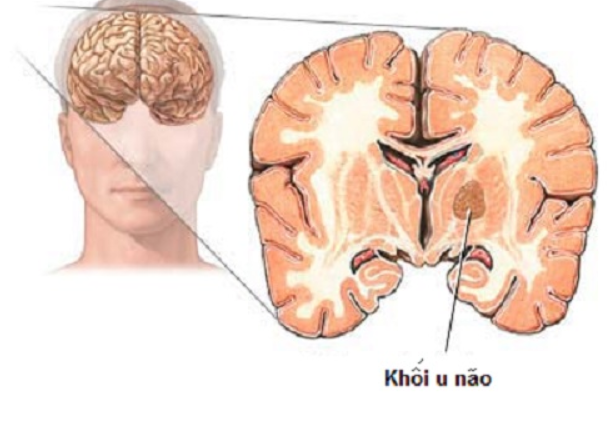 nhức đầu liên tục nhiều ngày do u não