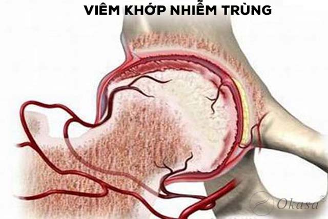 Những điều cần biết về khớp gối có mủ do viêm, nhiễm khuẩn