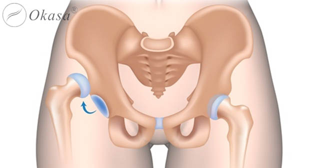Những điều cần biết về thay lại khớp háng