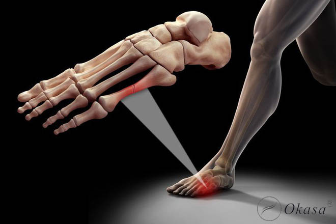 Những điều cần lưu ý khi chăm sóc người bị gãy xương bàn chân