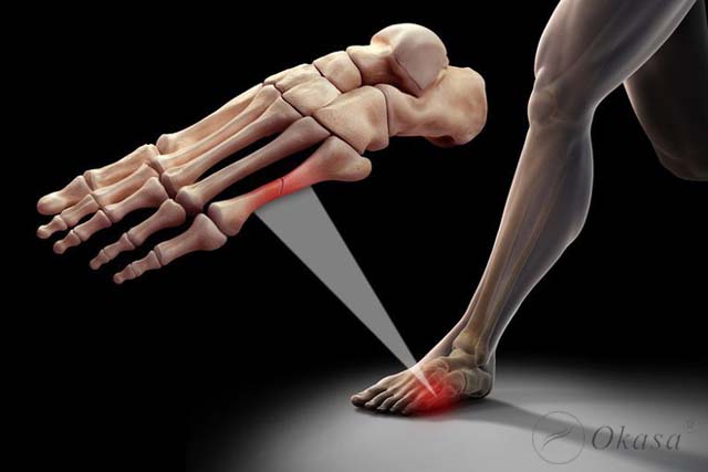 Những điều cần lưu ý khi xử lý chấn thương xương bàn chân