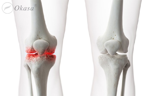 Những phương pháp điều trị thoái hóa khớp gối phổ biến, hiệu quả