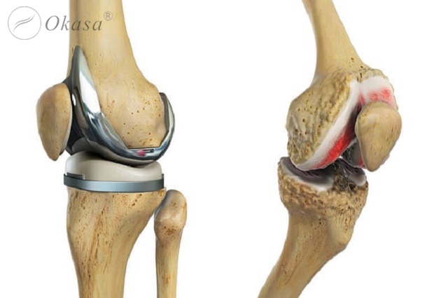 Những phương pháp điều trị thoái hóa khớp gối phổ biến, hiệu quả