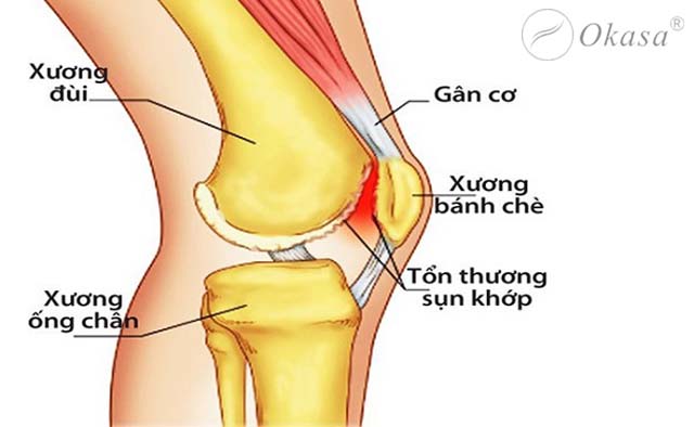 Những vấn đề cần lưu ý sau phẫu thuật mổ gối