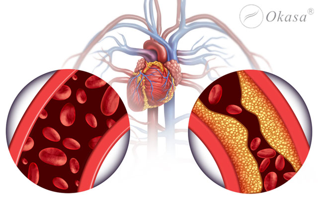 Những yếu tố nguy cơ gây ra bệnh tăng huyết áp có thể điều chỉnh được