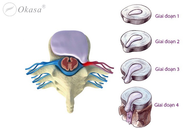 Phân loại thoát vị đĩa đệm