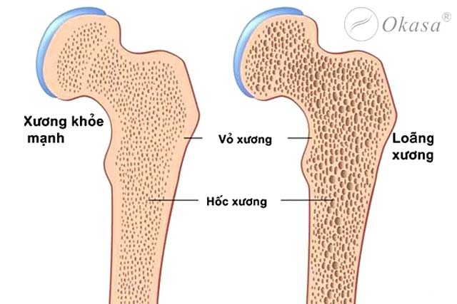 Phòng ngừa loãng xương cho phụ nữ mãn kinh
