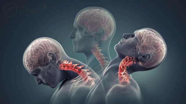 Phòng tránh nguy cơ thoái hóa đốt sống cổ cho dân công sở
