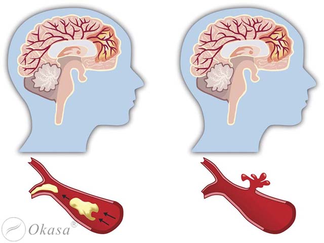 Phục hồi sau tai biến mạch máu não cần lưu ý gì?