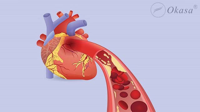 Phương pháp điều trị thiếu máu cơ tim